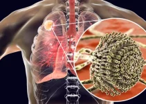Penyempitan Paru Paru: Cerita, Pelajaran, dan Tips Menghadapi Kondisi Ini